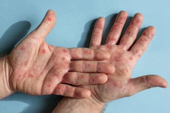 Tboli South Cotabato Confirms First Mpox Case; Health Officials Step Up Monitoring