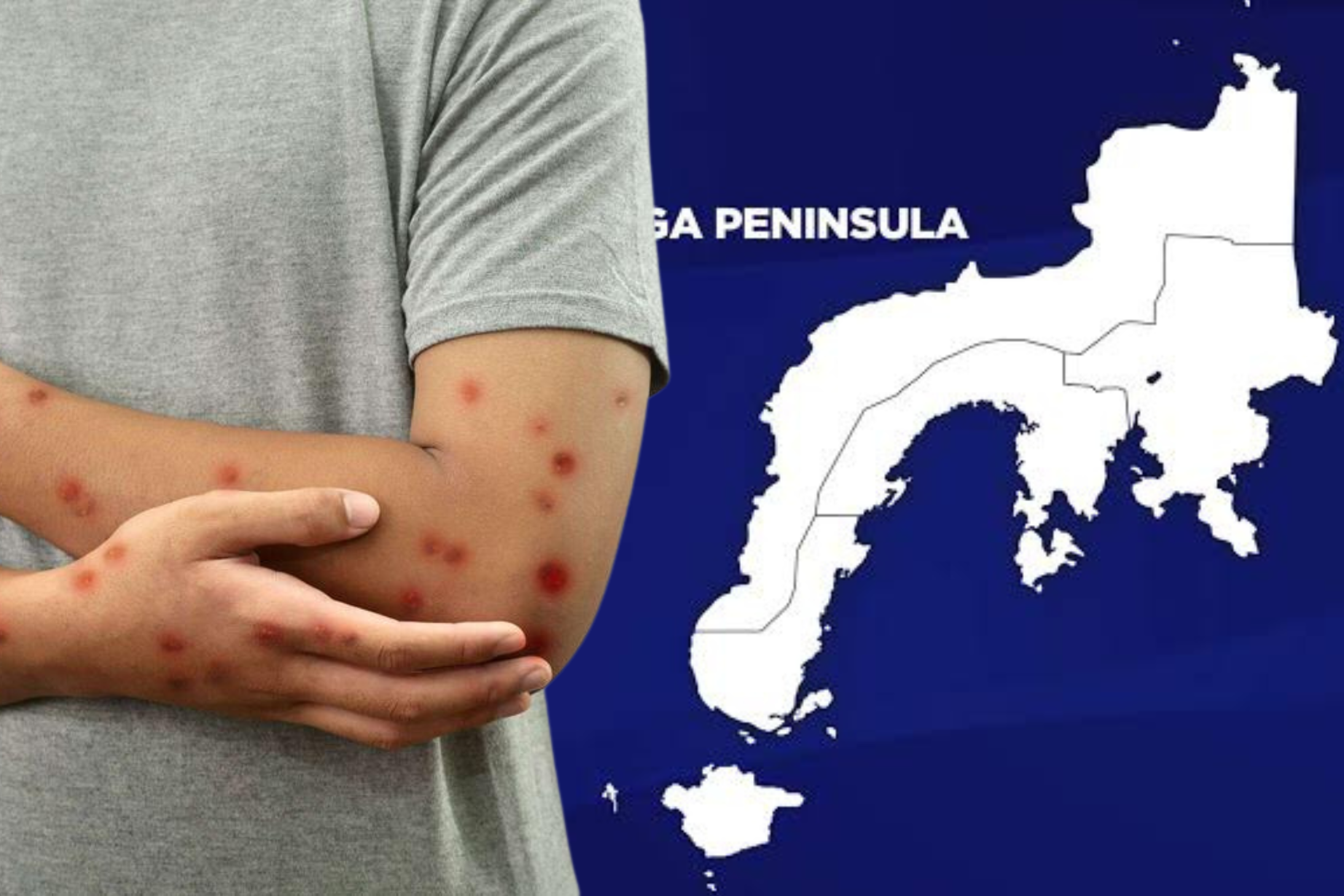 ZamPen Mpox Watch: Confronting the Threat of Mpox in the Zamboanga Peninsula