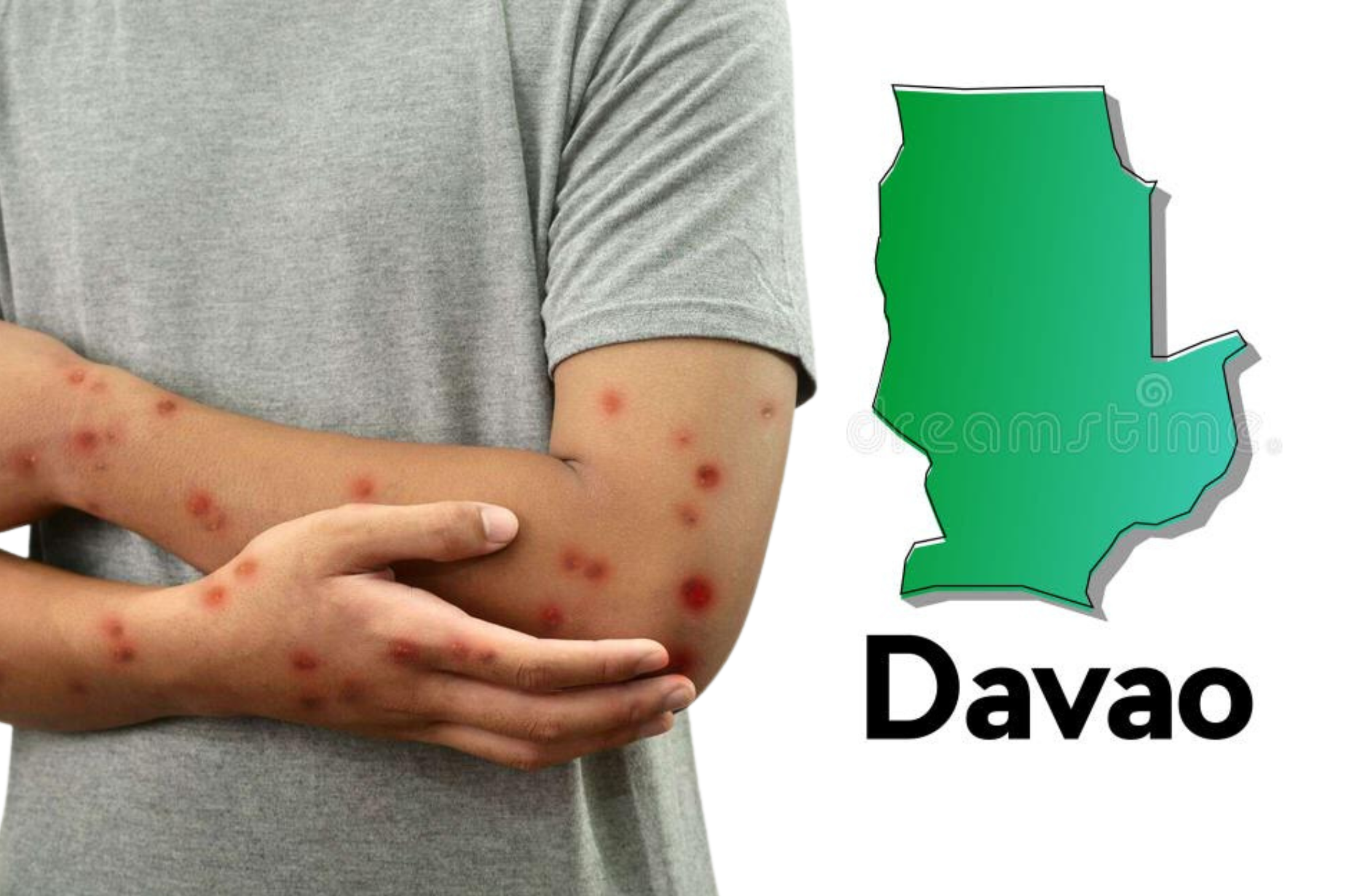 6 Mpox Cases Confirmed in Davao City; Local Health Office on High Alert | People’s Press PH